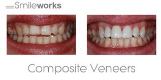 When you settle on the correct veneer kit company. Composite Bonding Liverpool Best And Worst Of 2021 Compared