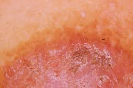 t eczema symptoms causes and