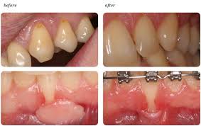 mint clinic aesthetic gum grafting in