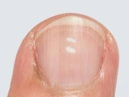 white spots on nails causes