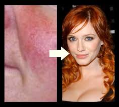 redheads can cover redness or rosacea