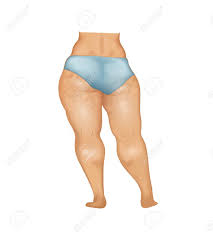 Woman's Buttocks And Legs With Cellulite Royalty Free SVG, Cliparts,  Vectors, and Stock Illustration. Image 96285890.