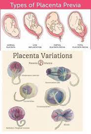 Placenta previa is a condition that is most commonly noticed in the later stages of pregnancy. Pin On Nursing School Study Tips Nclex
