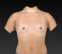 Two Ways to Adjust Nipple Direction with Breast Implants