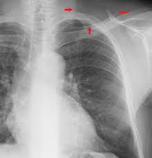 Most cases of rds occur in babies born before 37 weeks. Chest Radiograph Wikiwand