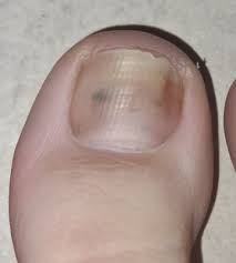 dr dnd help black spot under toenail