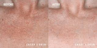 vbeam laser skin pigmentation