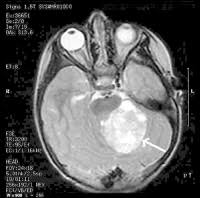 Brain Cancer Types Symptoms Signs Causes Stages Treatment