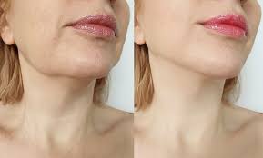 chin liposuction recovery time dr