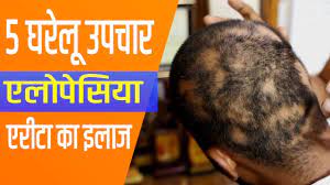 5 home remes for alopecia areata