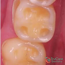 tooth cupping trucare dentistry