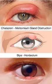 eyelid infections chalazion and stye