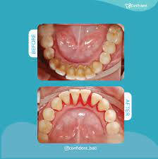 confident bali dental clinic best
