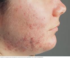 Acne Symptoms And Causes Mayo Clinic
