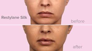 Restylane Vs Juvederm For Lips Whats The Difference