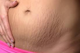 stretch marks try microneedling