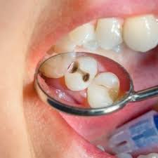 dental crowns wilton dental care