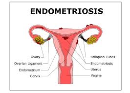 Areas of endometrial tissue found in ectopic locations are called endometrial implants. Endometriosis
