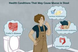 irritable bowel syndrome and mucus in stool
