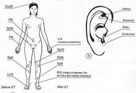what is acupuncture fertilityiq