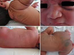 neonatal skin disorders