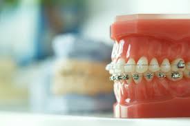 Braces work by gently moving your teeth into alignment with each other and correcting the dental arches. What Is An Underbite And How Can It Be Corrected