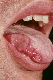 canker sore stock image c051 5139