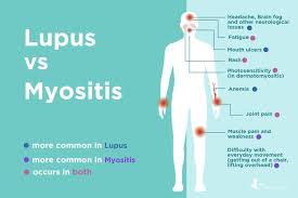 Lupus is an autoimmune disease that causes symptoms and signs like a butterfly rash, arthritis, hair loss, and read about lupus treatment, diagnosis, prognosis, causes, pregnancy flares, and diet. Lupus Vs Myositis Differences In Symptoms And Treatments