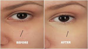 remove dark eye circles