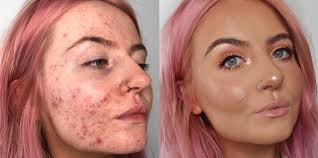 cystic acne sufferer