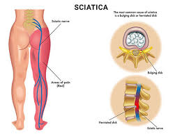 sciatica exercises what s best and