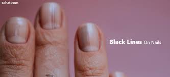 black lines on nails causes and tips