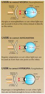 lasik laser vision correction burbank