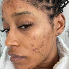 her acne journey and pcos diagnosis