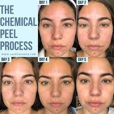 jessner chemical l before after