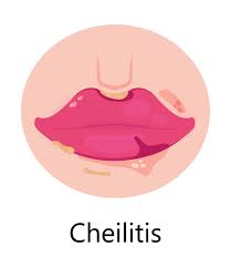 cheilitis lips symptoms causes and