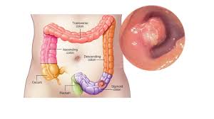 The colon is used to separate two independent clauses when the second explains or illustrates the in such usage, the colon functions in much the same way as the semicolon. Mayo Clinic Minute Symptoms Of Colon Cancer Youtube