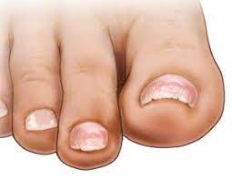 chipped brittle ling toenails