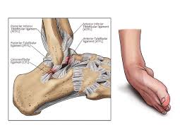 ankle pain treatment without injection
