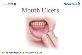 mouth ulcers remedy nuvovivo