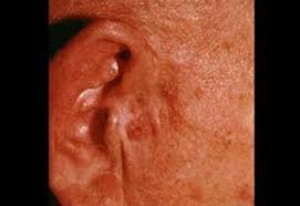 actinic keratosis pariser dermatology