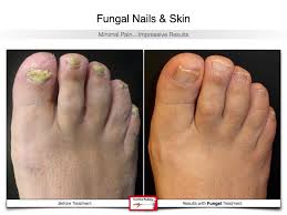 fungal nails foot first podiatry centers
