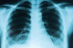 lung cancer lung cancer symptoms