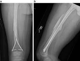 comminuted fem fracture treated