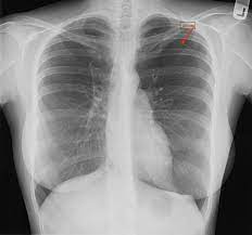 14 had surgical confirmation and nine had symptoms relief with hormonal treatment. Cureus Left Sided Catamenial Pneumothorax A Rare Clinical Entity