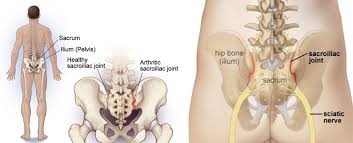 is it sciatica or si joint pain
