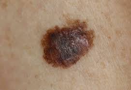 In more advanced melanoma, the texture of the mole may change. Skin Cancer Signs Symptoms And Complications