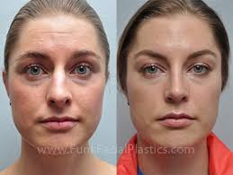 We did not find results for: Septoplasty Houston Deviated Septum Surgery Correction Funk Facial Plastic Surgery