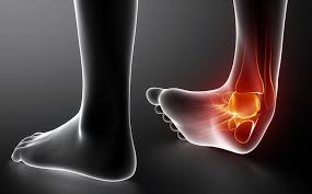 ankle sprain how to recover fast