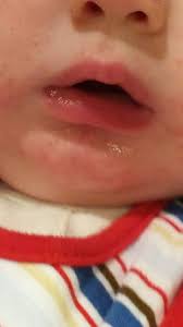 rash around baby s mouth babycenter